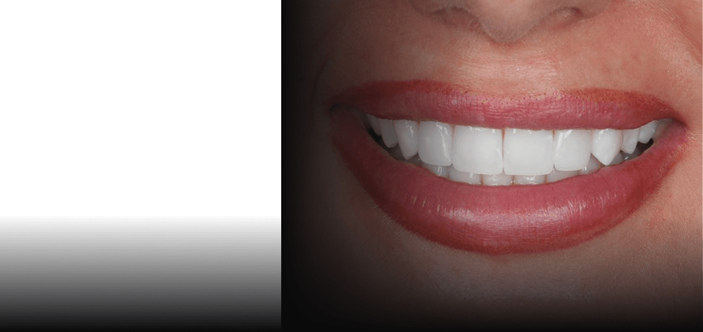 Close-up of a patient's smile after treatment