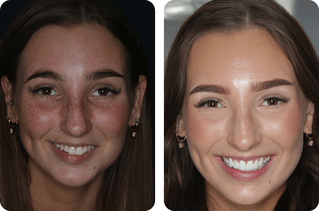 A patient's smile before and after a smile makeover
