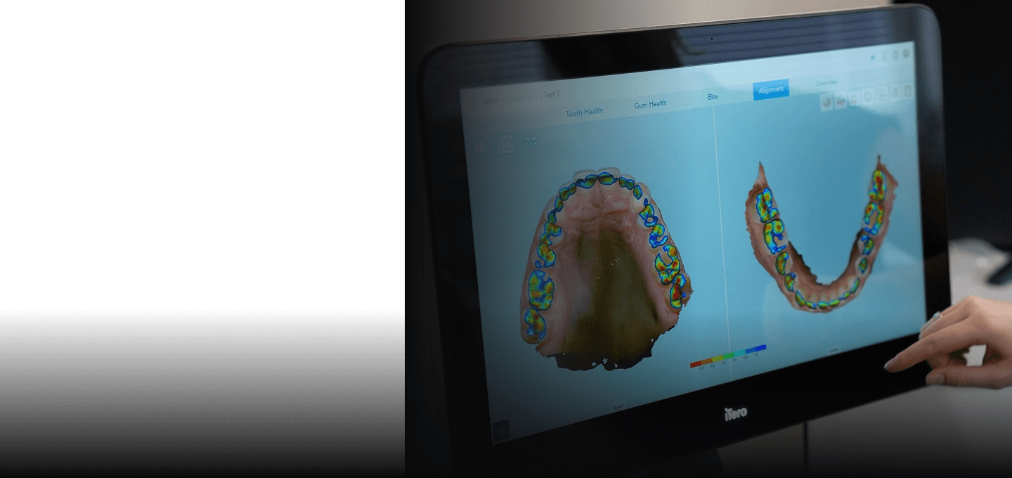 A digital scan of a patient's teeth shown on a screen during smile design